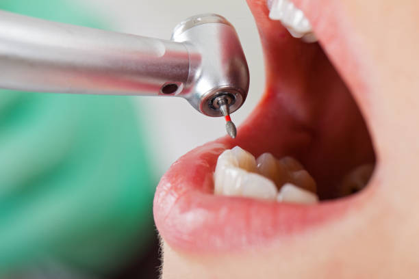 Best Emergency Dentist for Knocked-Out Tooth in Buckner, MO